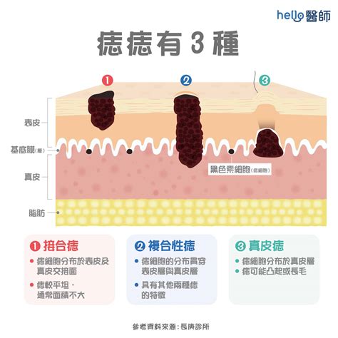 痣 生成原因|身體為什麼會長痣？深入剖析痣的成因與護理方法